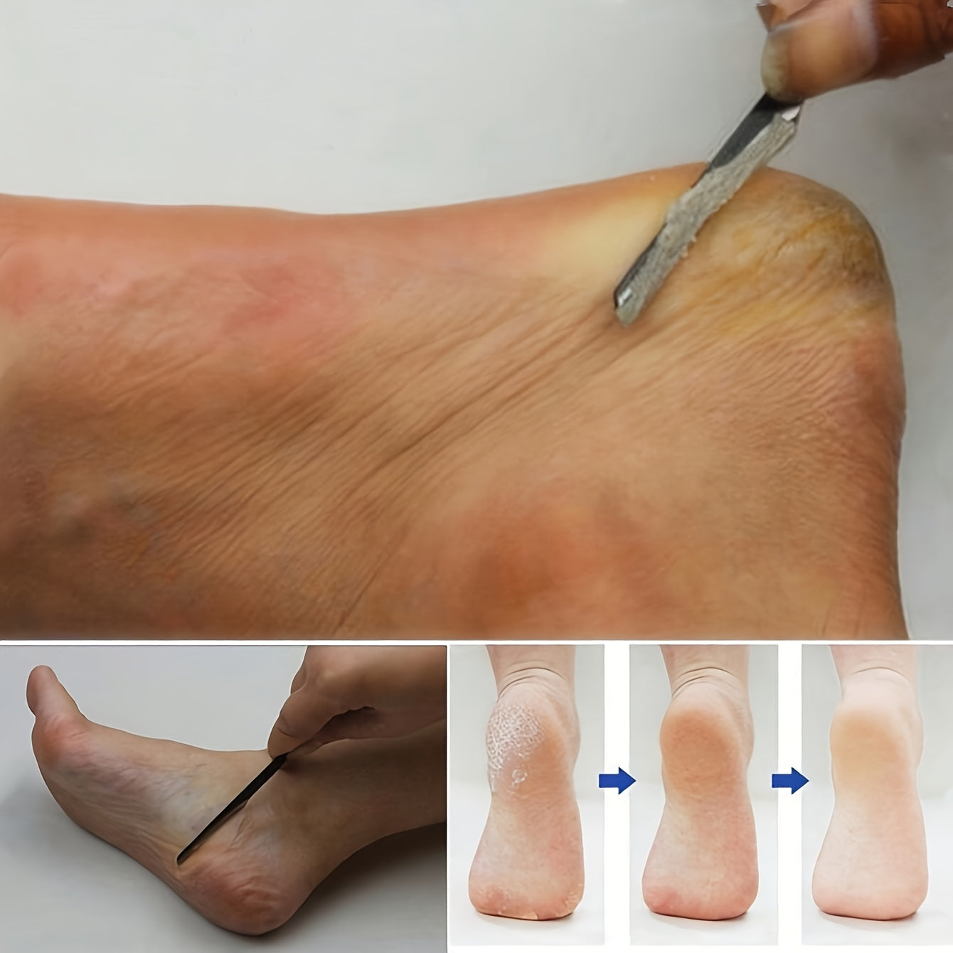 2 Piezas de Raspadores y Removedores de Pedicura de Acero Inoxidable Resistentes - Herramientas Profesionales con Cuchillas Afiladas, Empuñadura Antideslizante para Hogar, Salón o Spa - Sin Batería Necesaria, Fácil de Limpiar y Guardar