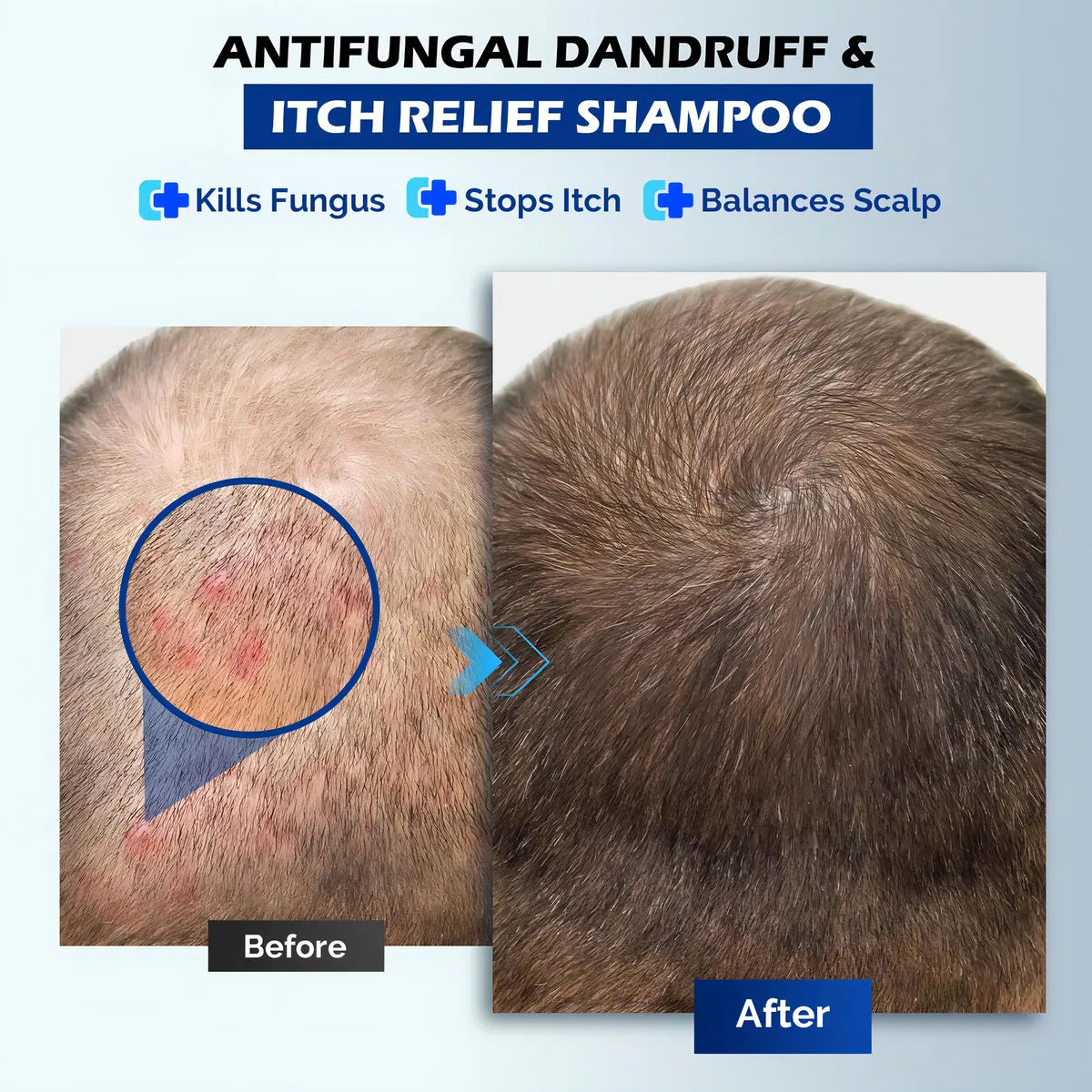 Champú Antifúngico Para Dermatitis Seborreica Y Caspa