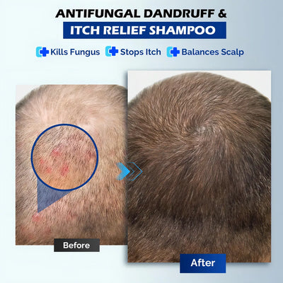 Champú Antifúngico Para Dermatitis Seborreica Y Caspa